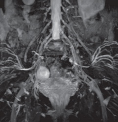 МР нейрография крестцового сплетения