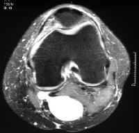 МРТ колена в аксиальной проекции мрт коленого сустава мрт томография колена