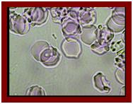 бактериальное обсеменение плазмы крови, гемосканирование крови