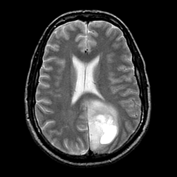 Опухоль головного мозга на МРТ (глиома), головная боль, мигрень