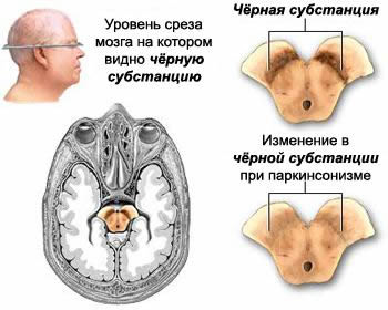 Зона поражения чёрной субстанции ствола головного мозга при болезни Паркинсона, Болезнь Паркинсона, паркинсонизм, диагностика болезни Паркинсона, диагностика паркинсонизма, лечение болезни Паркинсона, лечение паркинсонизма