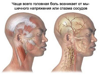 Сосудистая головная боль и головная боль напряжения самые частые по встречаемости у пациентов, головная боль, головная боль напряжения, мигрень