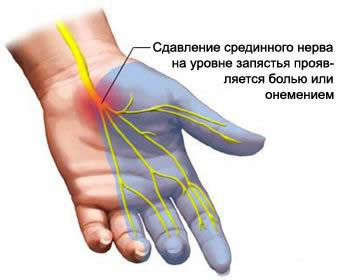 Место компрессии срединного нерва при туннельном синдроме на уровне карпального канала, Туннельный синдром, синдром карпального канала, синдром запястного канала, запястный синдром, синдром перегруженного запястья, запястный туннельный синдром, запястный канал, синдром лучезапястного сустава, кистевой туннельный синдром, онемение пальцев руки, онемение пальцев рук, онемение пальцев, онемение пальца, немота пальцев, немота пальца, боли в пальцах, затекание пальцев, затекание пальца, боли в запястье, боли в кисти, боль в кисти, болят кисти рук, болят кисти, затекают кисти, затекают руки, лечить туннельный синдром, лечить синдром карпального канала, лечить синдром запястного канала, лечить запястный синдром, лечить синдром перегруженного запястья, лечить запястный туннельный синдром, лечить запястный канал, лечить синдром лучезапястного сустава, лечить кистевой туннельный синдром, лечить онемение пальцев руки, лечить онемение пальцев рук, лечить онемение пальцев, лечить онемение пальца, лечить немоту пальцев, лечить немоту пальца, лечить боли в пальцах, лечить затекание пальцев, лечить затекание пальца, лечить боли в запястье, лечить боли в кисти, лечить боль в кисти, лечение туннельного синдрома, лечение синдрома карпального канала, лечение синдрома запястного канала, лечение запястного синдрома, лечение синдрома перегруженного запястья, лечение запястного туннельного синдрома, лечение запястного канала, лечение синдрома лучезапястного сустава, лечение кистевого туннельного синдрома, лечение онемения пальцев руки, лечение онемения пальцев рук, лечение онемения пальцев, лечение онемения пальца, лечение немоты пальцев, лечение немоты пальца, лечение боли в пальцах, лечение затекания пальцев, лечение затекания пальца, лечение боли в запястье, лечение боли в кисти