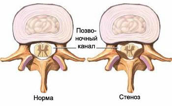 Стеноз позвоночного канал со сдавлением спинного мозга, грыжа межпозвоночного диска, протрузия межпозвоночного диска, грыжа шморля