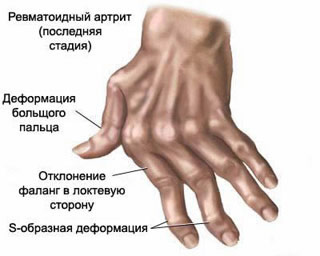 Типичная деформация фаланг пальцев кисти у больного ревматоидным артритом, Ревматоидный артрит, Ревматоидный, Ревматизм, лечение ревматоидного артрита, диагностика ревматоидного артрита, лечить ревматоидный артрит, лечить ревматизм, лечение ревматизма, диагностика ревматизма в Санкт-Петербурге