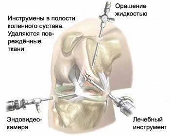 Эндоскопическая операция на коленном суставе при разрыве связок и мениска