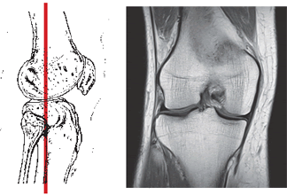 Проведение МРТ коленного сустава во фронтальной проекции (связки, мениск, суставной хрящ) при диагностике остеоартроза (гонартроза), Заболевания коленного сустава: артрит, артроз, остеоартроз, гонартроз, Артрит коленного сустава, артрит коленного сустава, артроз коленного сустава, суставная жидкость, суставной хрящ, остеоартроз коленного сустава, диагностика коленного сустава, лечение коленного сустава, диагностика гонартроза, лечение гонартроза