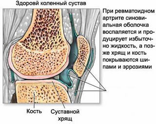 Вид сбоку на коленный сустав в разрезе, Ревматоидный артрит, Ревматоидный, Ревматизм, лечение ревматоидного артрита, диагностика ревматоидного артрита, лечить ревматоидный артрит, лечить ревматизм, лечение ревматизма, диагностика ревматизма